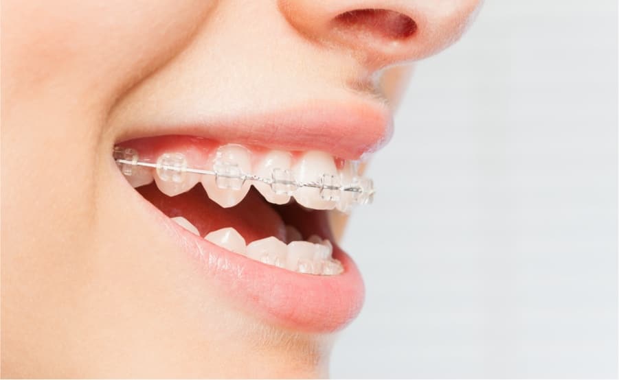 clear braces on patient