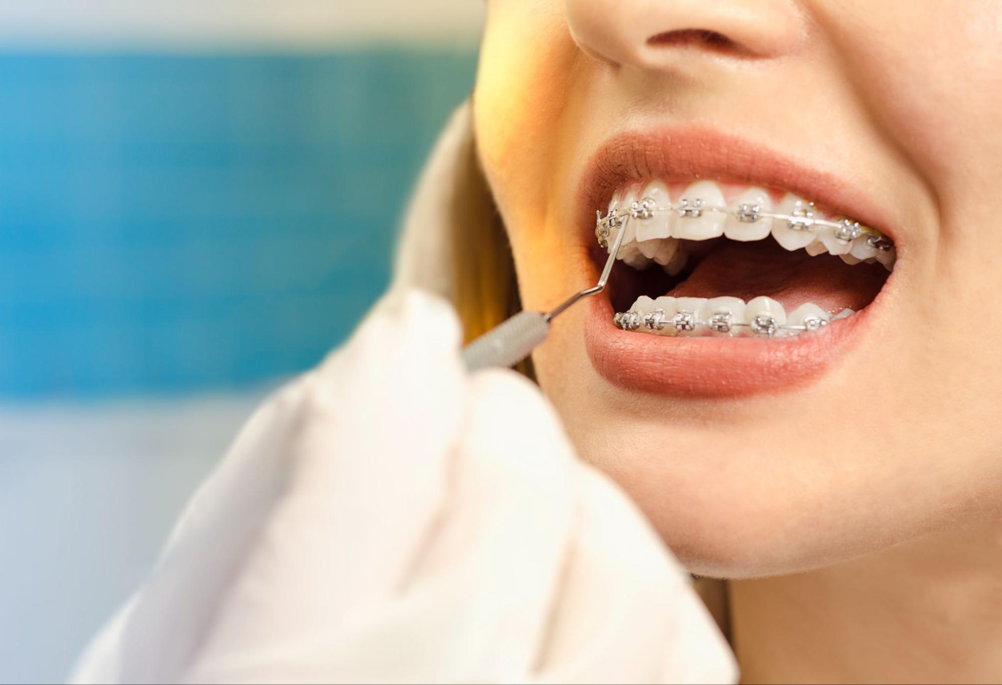 Should Adults Get Orthodontic Treatment?